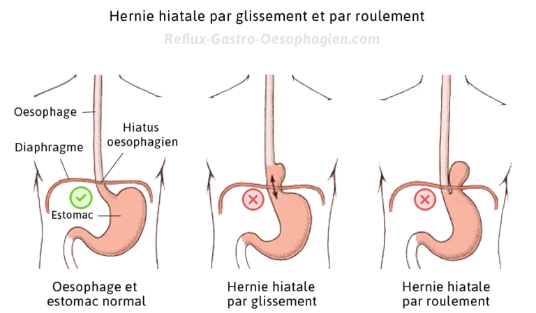 Hernie Hiatale Douleur Au Dos Reflux Gastro Oesophagien Reflux