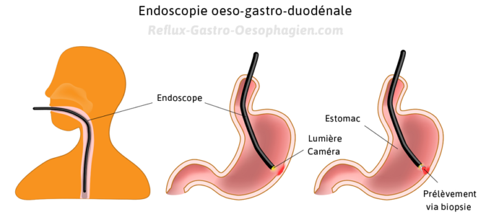 Diagnostic Du Reflux Gastrique Reflux Gastro Oesophagien Reflux