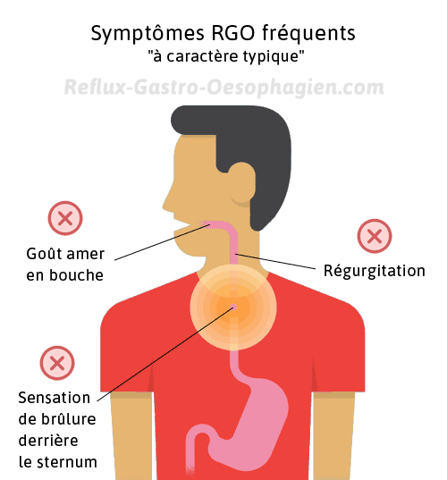 Reflux gastrique symptomes