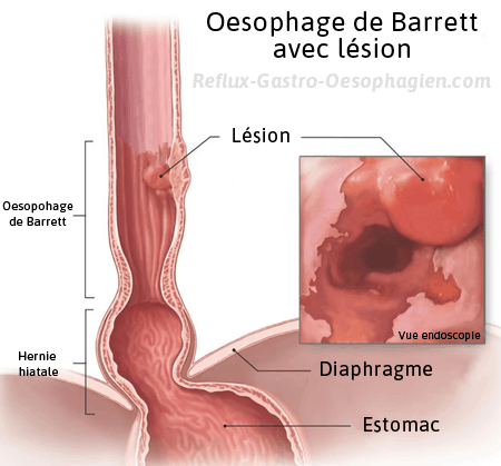 Endobrachyoesophage oesophage de Barrett