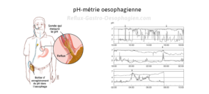pH-métrie oesophage