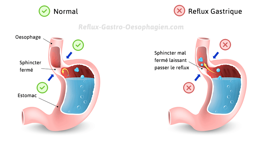reflux gastro-oesophagien sphincter