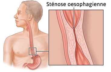 Sténose oesophage
