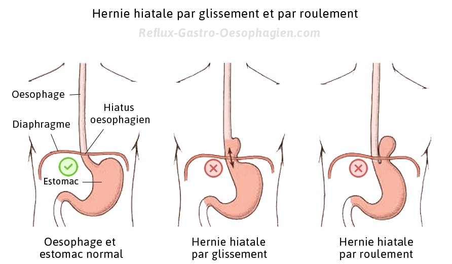 Hernie Hiatale Description Symptomes Complications Causes Traitement Reflux Gastro Oesophagien Reflux Gastrique