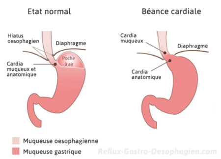 Cardia de l'estomac : définition, description, rôle, complications ...