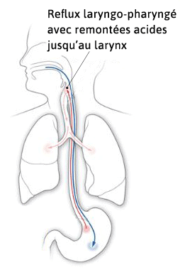 reflux laryngo-pharyngé gorge toux