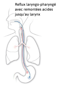 reflux-gastrique cordes vocales enrouement voix