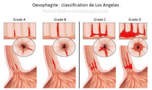 Oesophagite classification Los Angeles