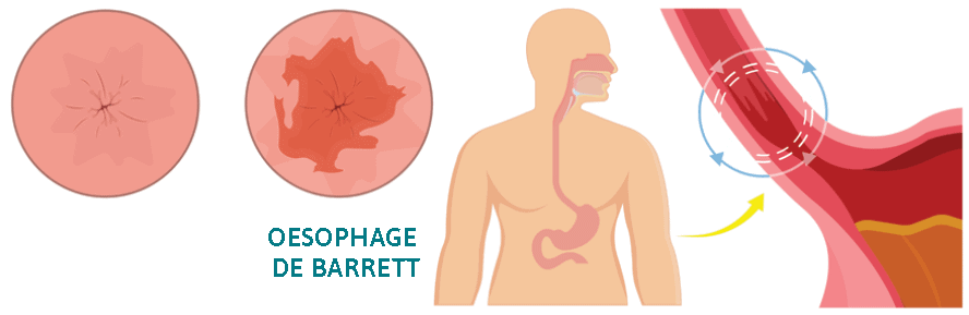 oesophage de Barrett complication oesophagite peptique
