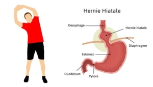 Hernie hiatale exercices physiques