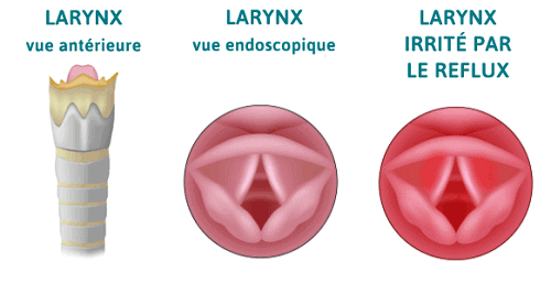 reflux laryngo-pharyngé - RLP