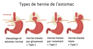 types hernie estomac