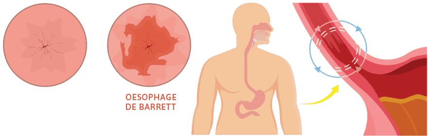 oesophage de Barrett endobrachyoesophage