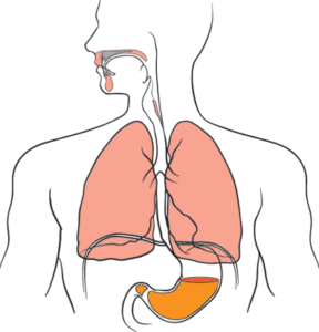 reflux gastrique dans les poumons