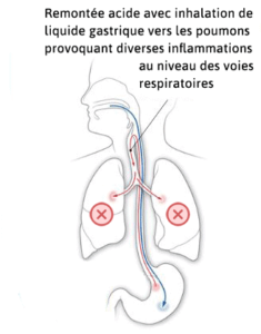 reflux gastrique poumons