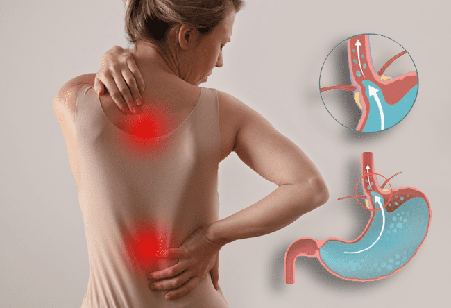 reflux gastrique et douleur de dos