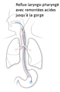 reflux gastrique symptôme a la gorge