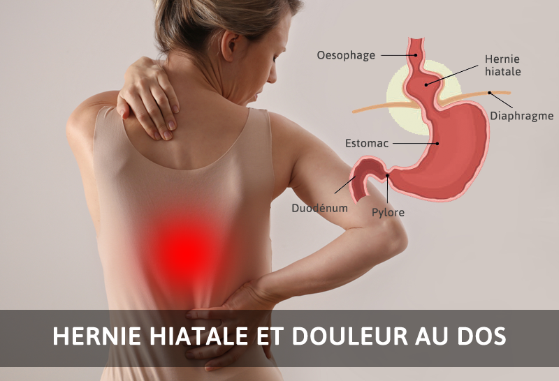 HERNIE HIATALE ET DOULEUR AU DOS
