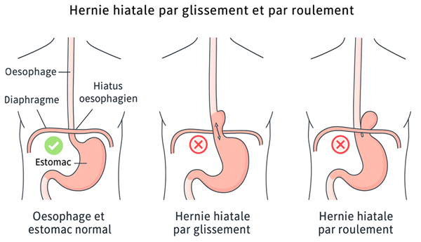 hernie hiatale symptômes