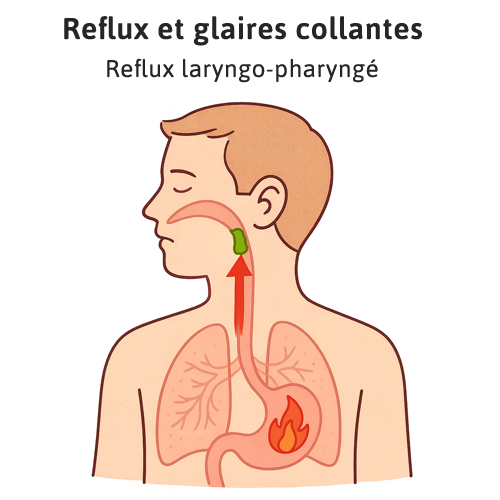 glaires collantes dans la gorge cancer