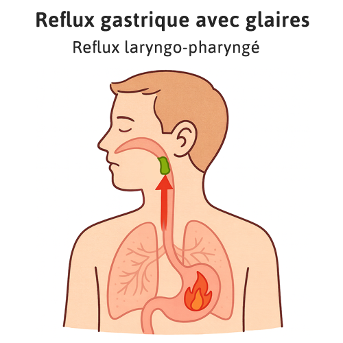 reflux gastrique avec glaires