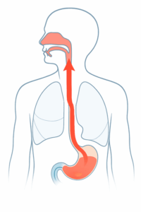 Reflux gastrique et nez bouché