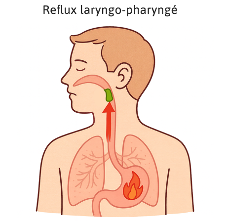 reflux pharyngo-laryngé
