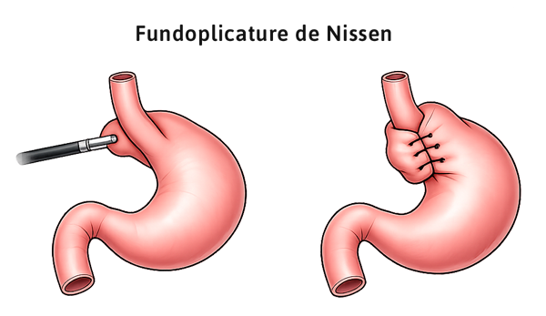 Opération hernie hiatale