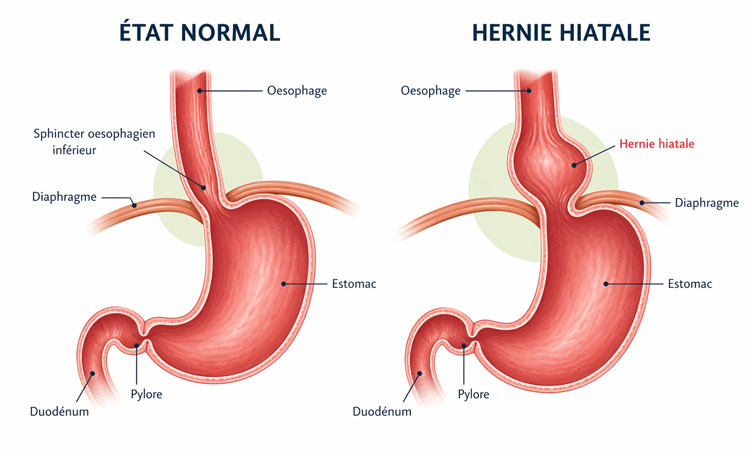 Hernie hiatale