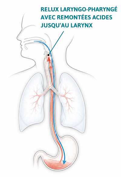 reflux silencieux remontées acides